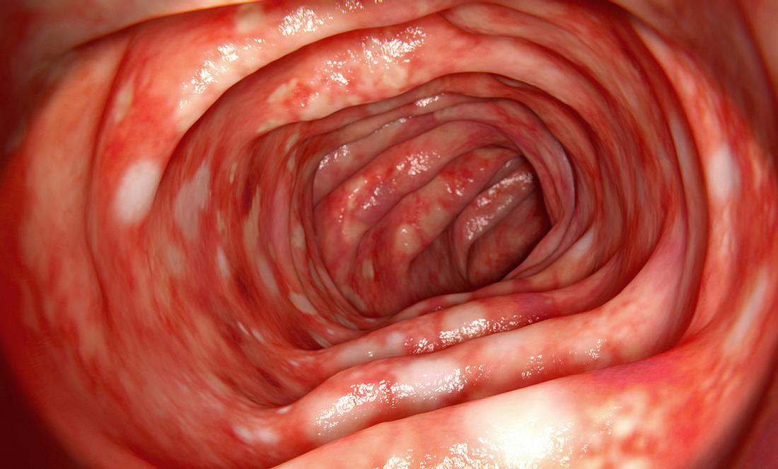Eine - bei der Darmsiegelung festgestellte - Colitis ulcerosa