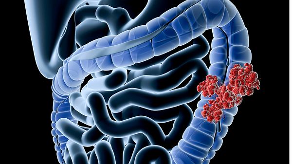 Darmkrebs Alter – wann bin ich Risikogruppe? - Foto: iStock/Raycat