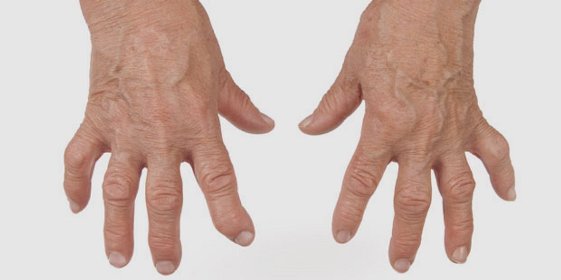 Deformierungen der Hände sind Symptome für Rheuma