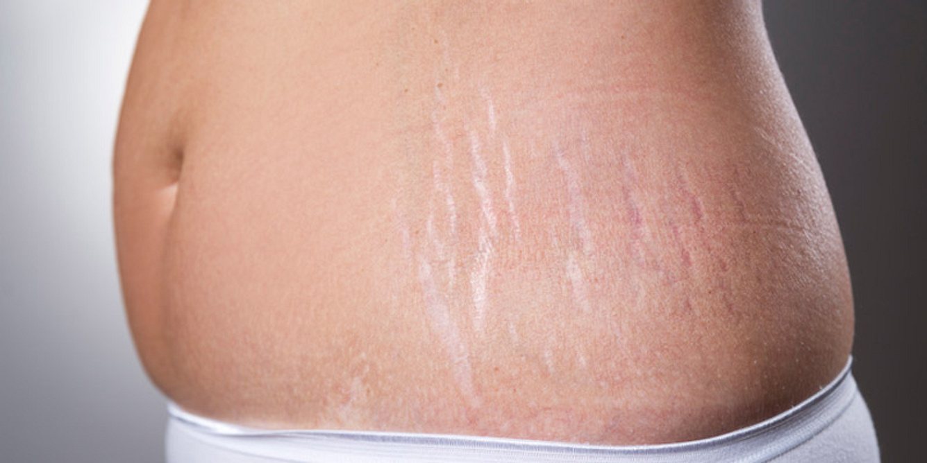 Auf der Haut einer Frau zeichnen sich Schwangerschaftsstreifen ab