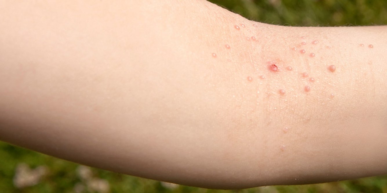 Dellwarzen auf dem Arm