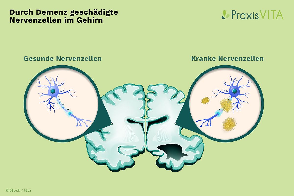 Grafik gesunder und geschädigter Nervenzellen bei Demenz