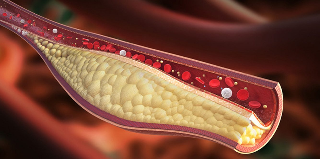 Erhöhtes Cholesterin