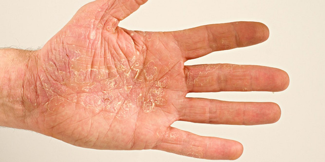 Trockene Haut durch Neurodermitis