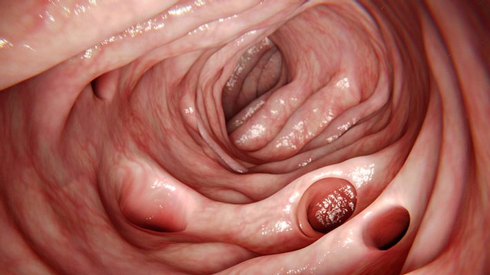 Bei einer Divertikulitis entzünden sich die Darmausstülpungen im Dickdarm - Foto: iStock