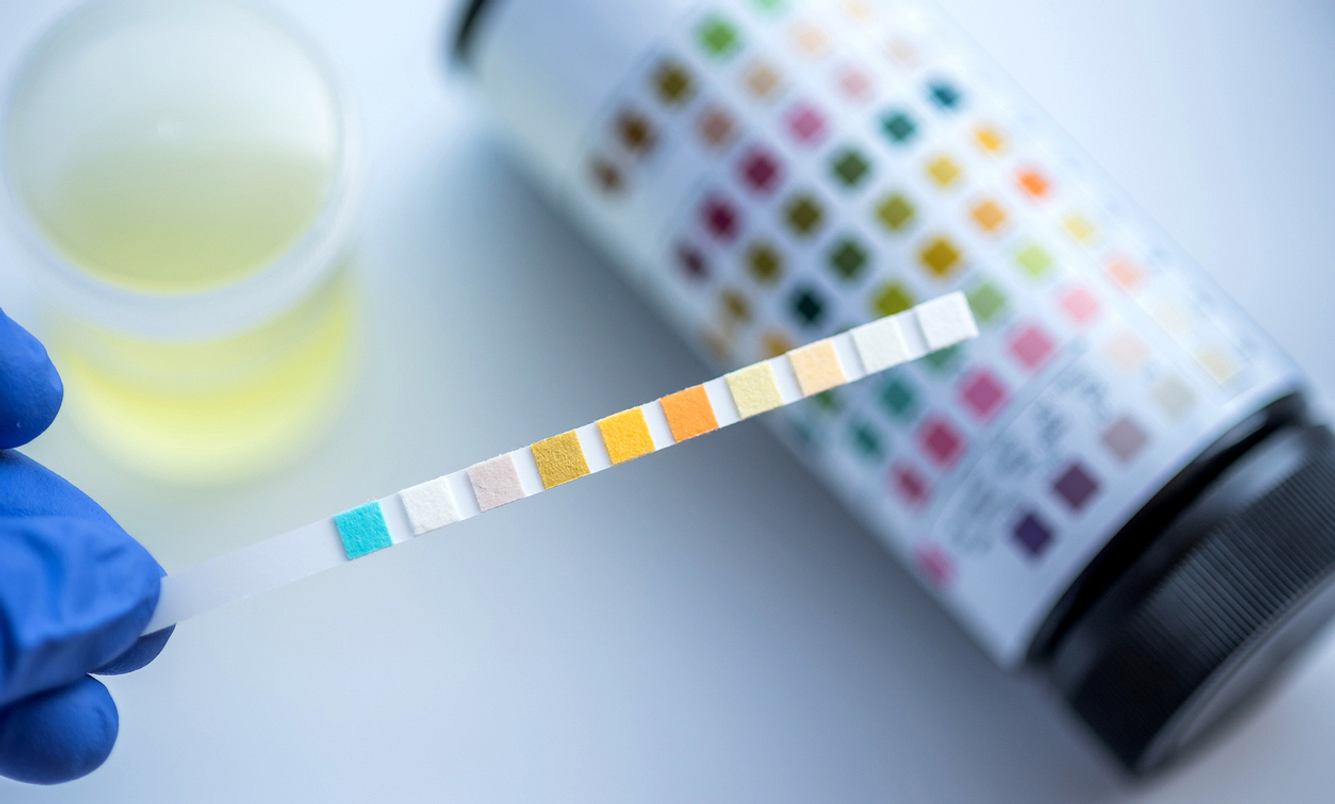 Teststreifen für Urinschnelltest mit Urinprobe und Farbfeldern zum Auswerten