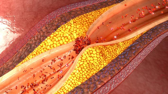 Arterielle Durchblutungsstörungen - Foto: istock