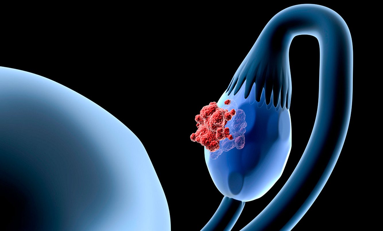 Eierstock mit Tumor