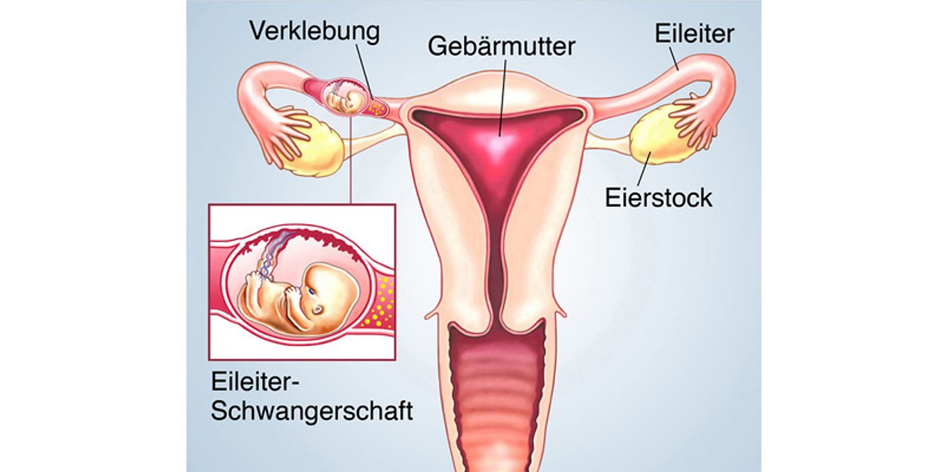 Bei einer Eileiterschwangerschaft nistet sich eine befruchtete Zelle im Eileiter anstelle der Gebärmutter ein