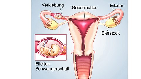 Bei einer Eileiterschwangerschaft nistet sich eine befruchtete Zelle im Eileiter anstelle der Gebärmutter ein - Foto: Fotolia