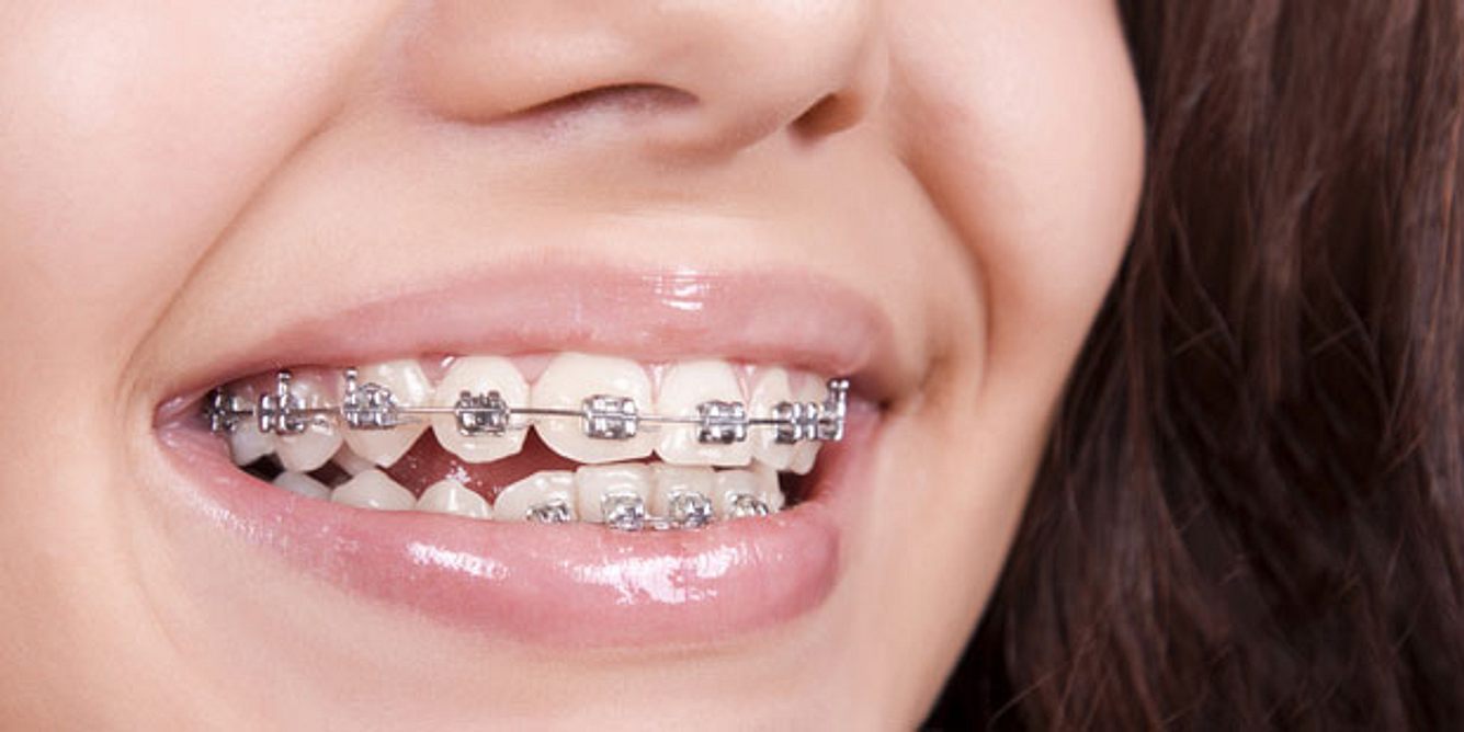 Zahnspangen können eingerissene Mundwinkel verursachen