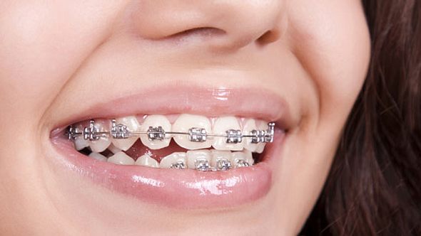 Zahnspangen können eingerissene Mundwinkel verursachen - Foto: Fotolia