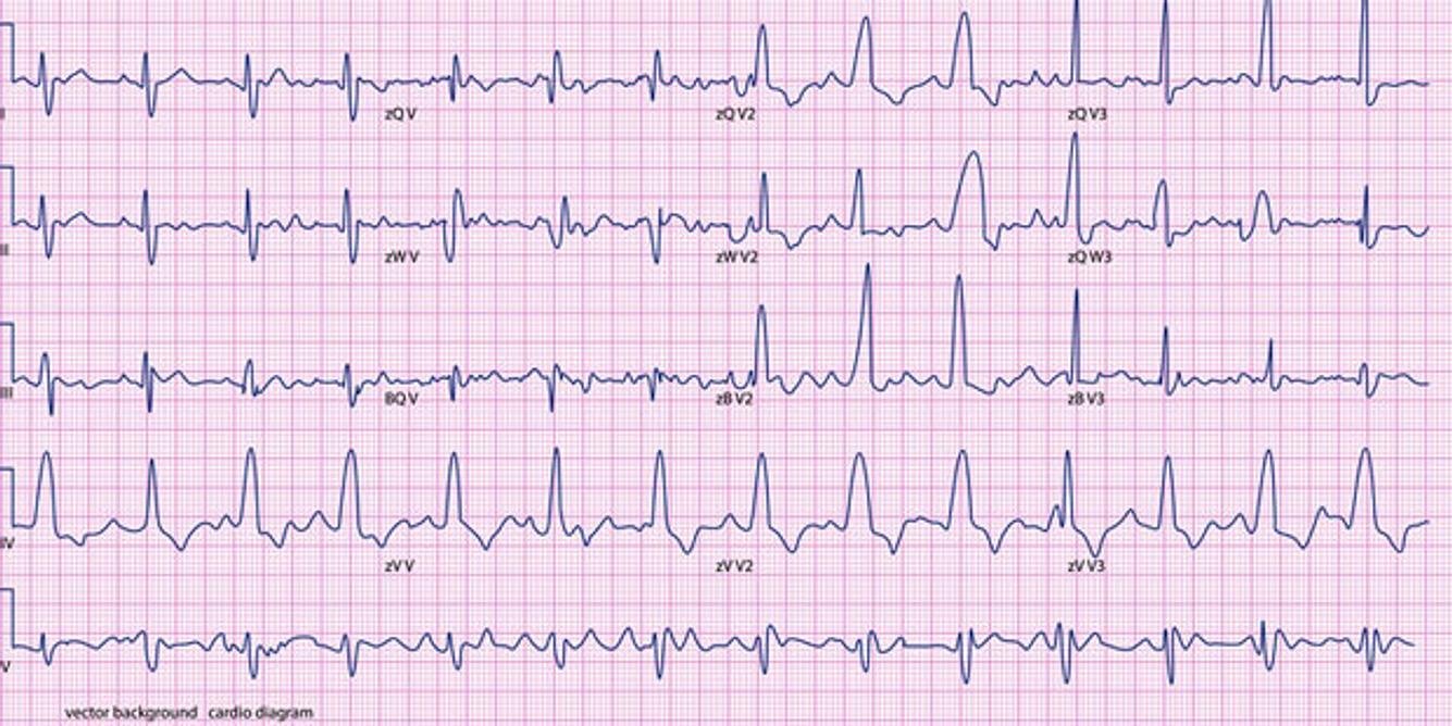 EKG erkennt Herzrhythmusstörungen