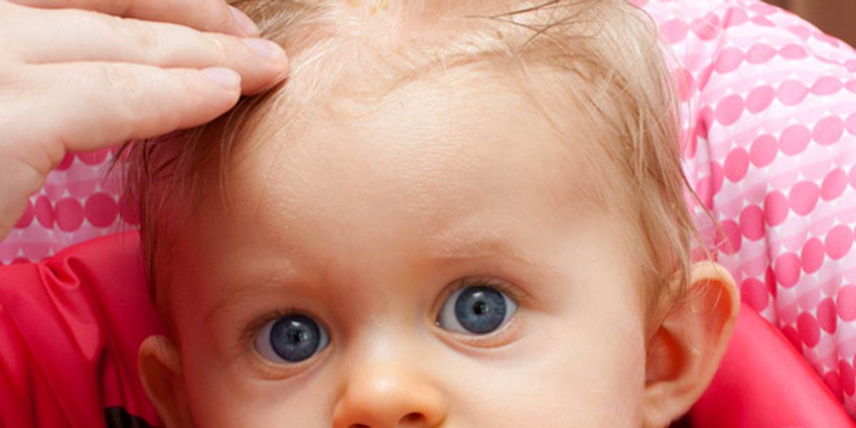 Milchschorf auf der Kopfhaut beim Baby ist völlig harmlos