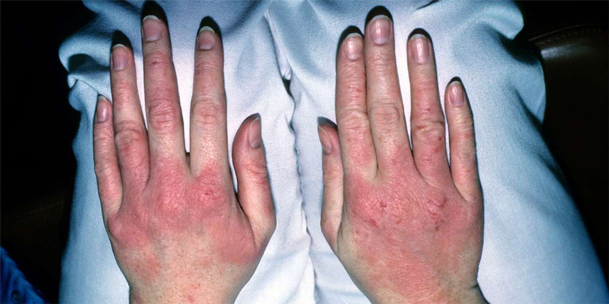 Eine Kontaktdermatitis auf Händen