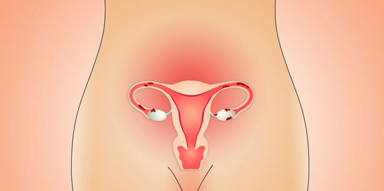Endometriose