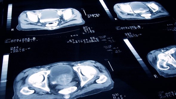 Ein Ultraschall von einer Prostata - Foto: iStock_jamesbenet