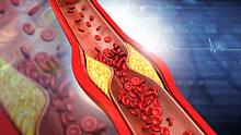 Ein Querschnitt einer Arterie, in der Blutfette zu einer Verengung führen und Blutzellen nicht mehr gut durch kommen. - Foto: iStock / Rasi Bhadramani