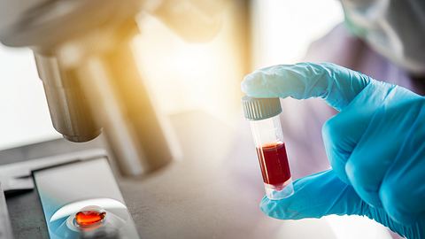 Person hält Laborprobe in der Hand - Foto: Istock/Totojang