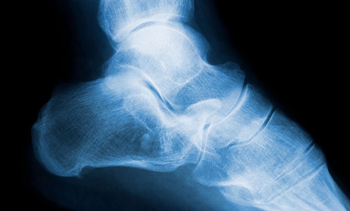 Röntgenbild von Fersensporn