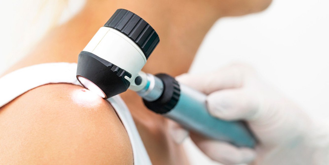 Mithilfe eines sogenannten Dermatoskops kann der Hautarzt eine genaue Fibrom-Diagnose stellen