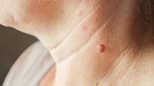 Eine Person mit einer Stielwarze am Hals - Foto: iStock / LENblR