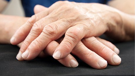 Eine Frau mit Fingerathrose zeigt ihre Hände. - Foto: iStock/Suze777
