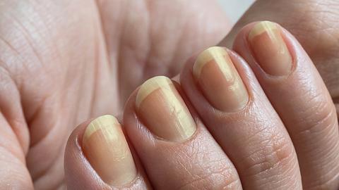 Gelbe Fingernägel: Ursachen und Tipps, um gelbe Nägel loszuwerden - Foto: iStock / Stanislav Sablin