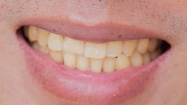Gelbe Zähne trotz putzen betrifft viele Menschen. - Foto: iStock/coffeekai