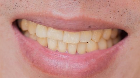 Gelbe Zähne trotz putzen betrifft viele Menschen. - Foto: iStock/coffeekai