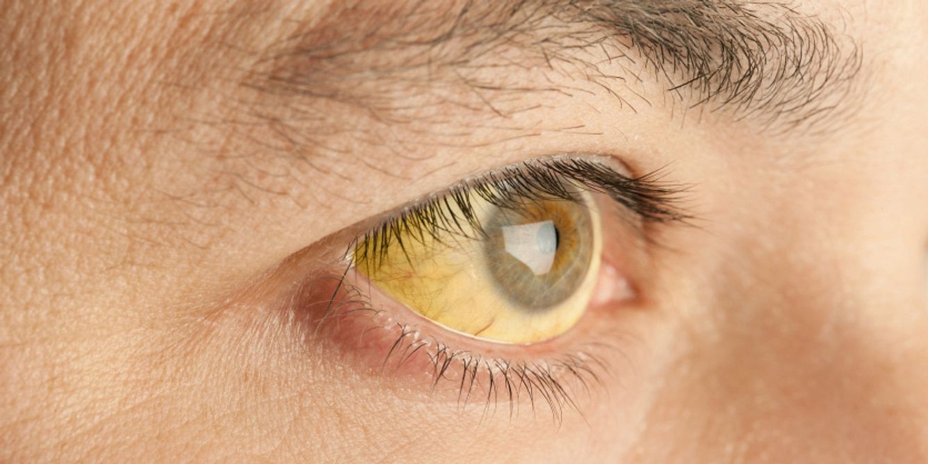 Bei einer Gelbsucht verfärben sich meist zuerst die Augen