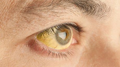 Bei einer Gelbsucht verfärben sich meist zuerst die Augen - Foto: iStock