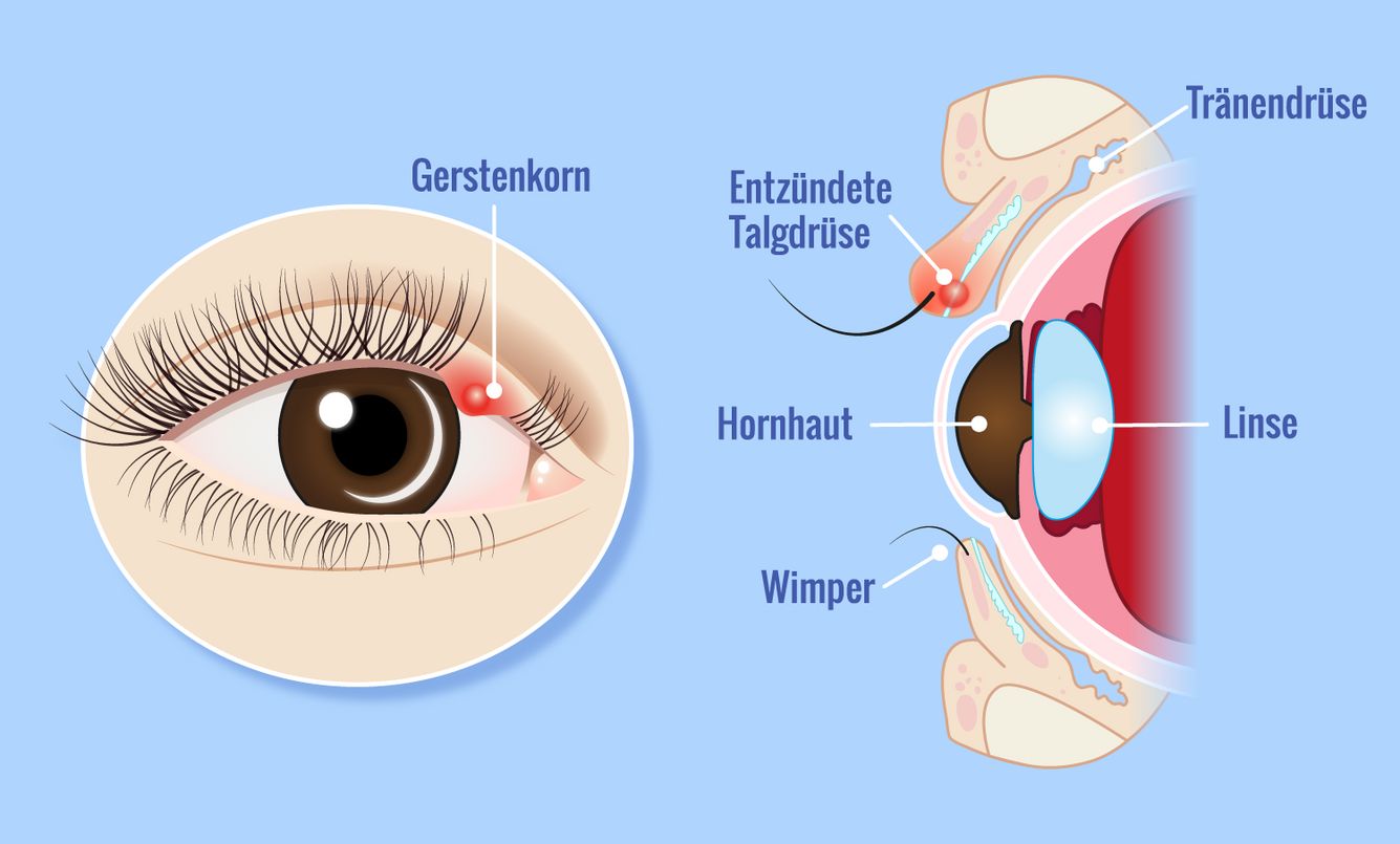 Ein Gerstenkorn ist eine akute, häufig eitrige Entzündung am Rand oder an der Innenseite der Augenlider
