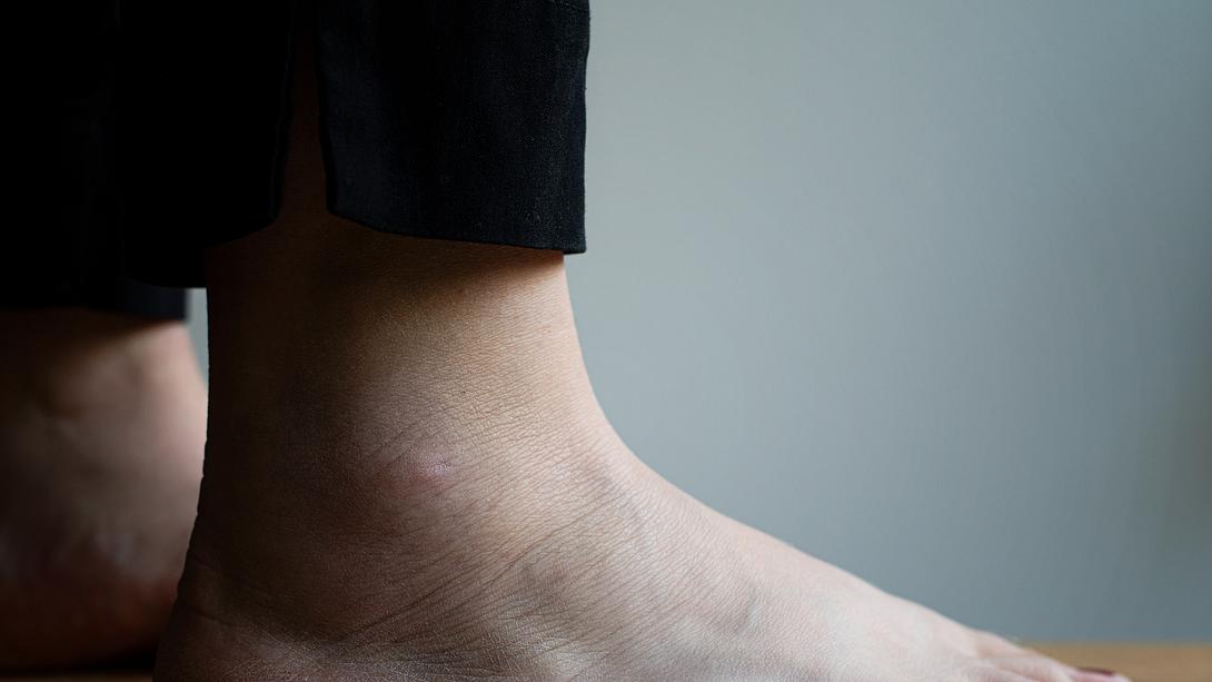 Eine Nahaufnahme von geschwollenen Knöcheln - Foto: iStock_Susie Hedberg 