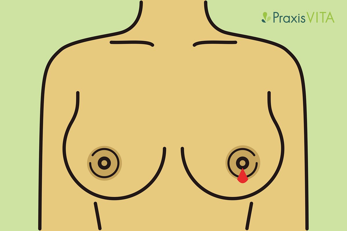 Grafik Ausfluss aus einer Brustwarze