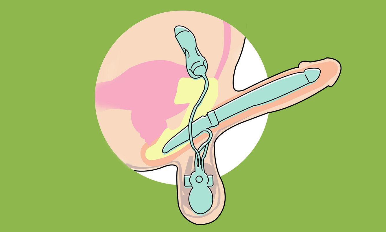 Die Penisprothese ermöglicht ein Anschwellen des Glieds