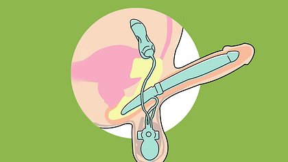 Die Penisprothese ermöglicht ein Anschwellen des Glieds - Foto: Dr. med. Franklin E. Kuehhas