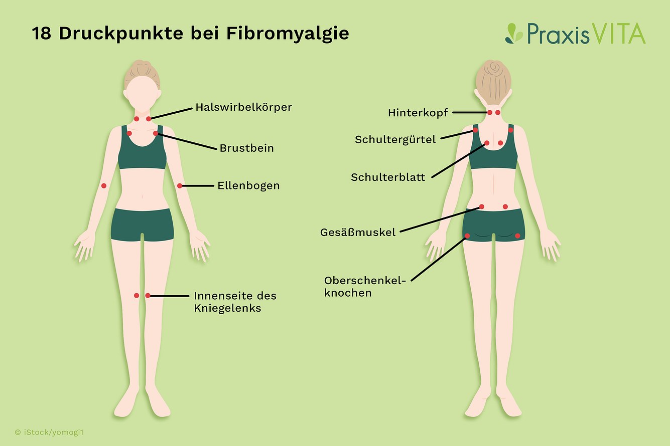 grafik-fibromyalgie-selbsttest-druckpunkte Grafik mit Triggerpunkten bei Fibromyalgie