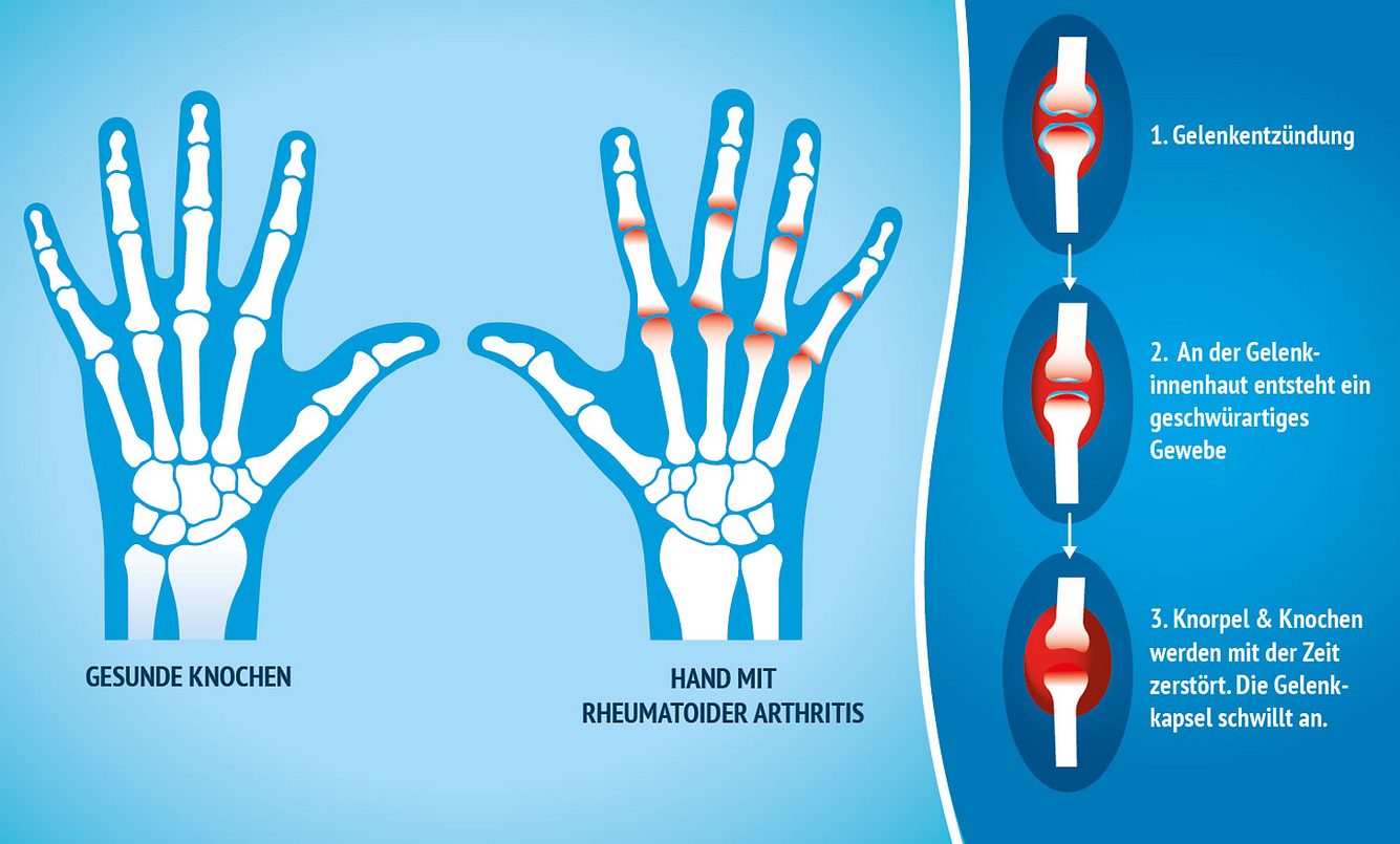 Grafik Arthritis