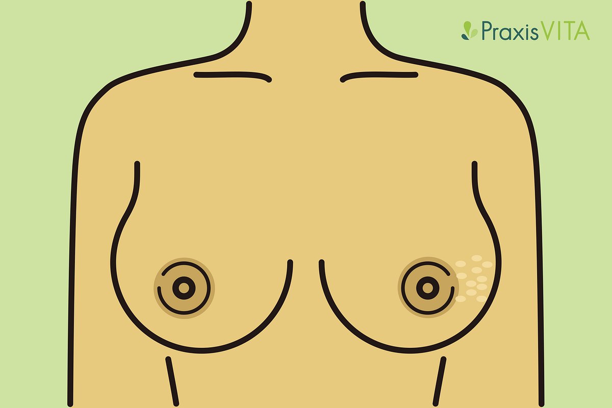 Grafik Hautveränderungen der Brust