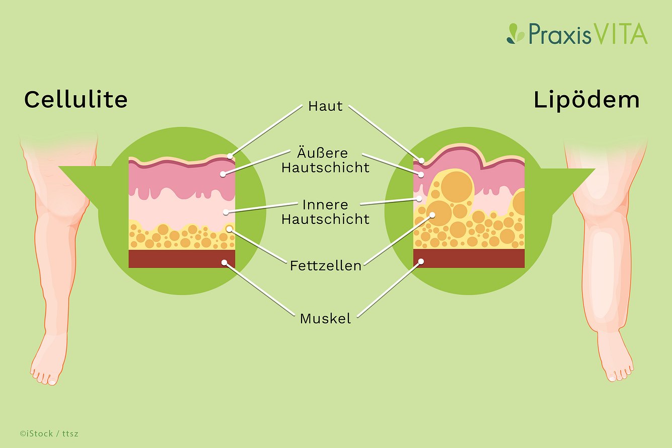 grafik-lipodem-und-cellulite Illustration von Cellulite und Lipödemen
