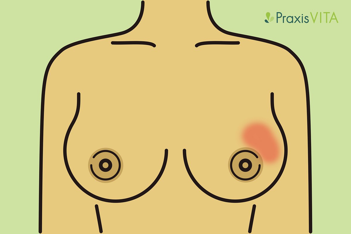Grafik Rötung einer Brust bei Brustkrebs