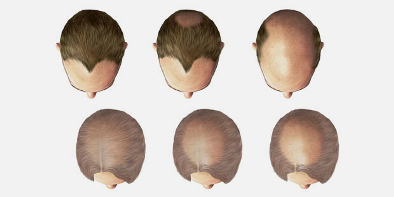 Typische Entwicklung des Haarausfalls bei Männern (oben) und bei Frauen (unten)