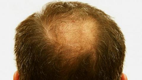 Was tun gegen Haarausfall? – Die Experten antworten