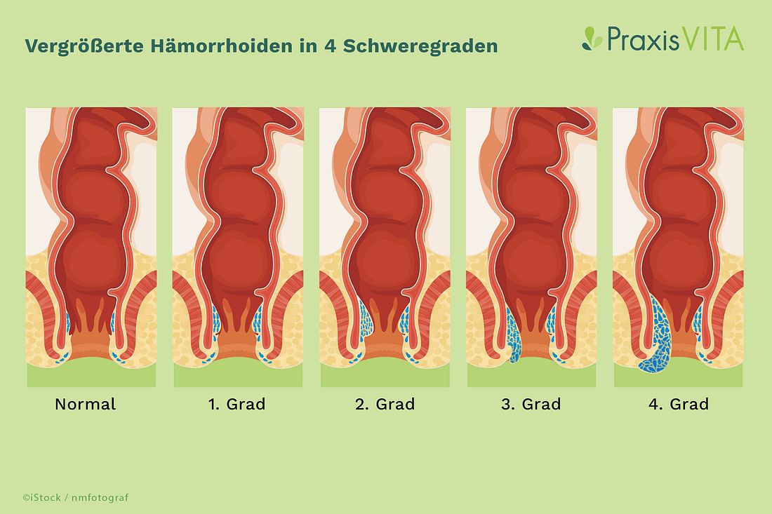 haemorrhoiden-grade Grafik Hämorrhoiden-Grade