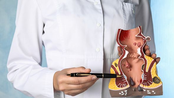 Ärztin zeigt mit Stift auf vergrößerte Hämorrhoiden in einem Enddarm-Modell - Foto: iStock/Liudmila Chernetska