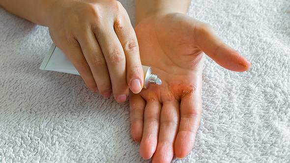 Eine Frau trägt eine Salbe auf ihre sich schälende Hand auf - Foto: iStock/Marina Vol