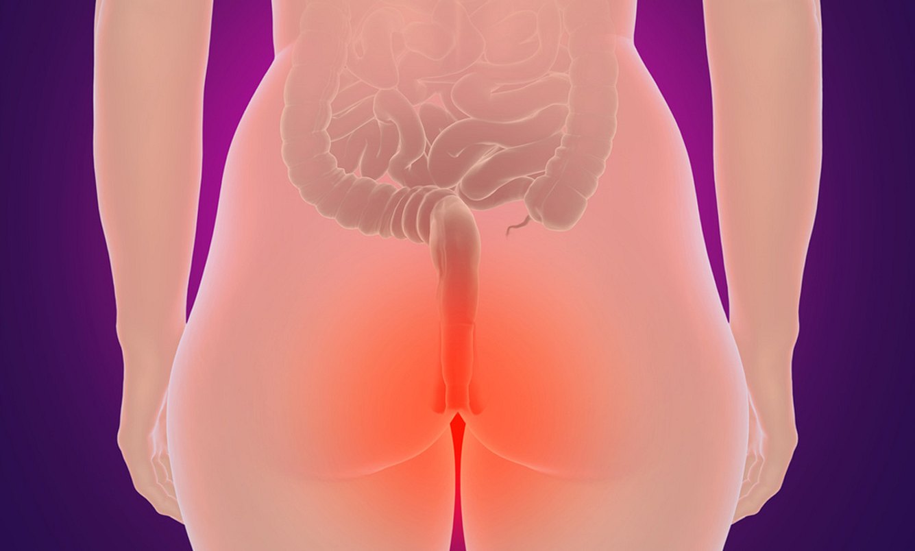 Frau mit Hämorrhoiden