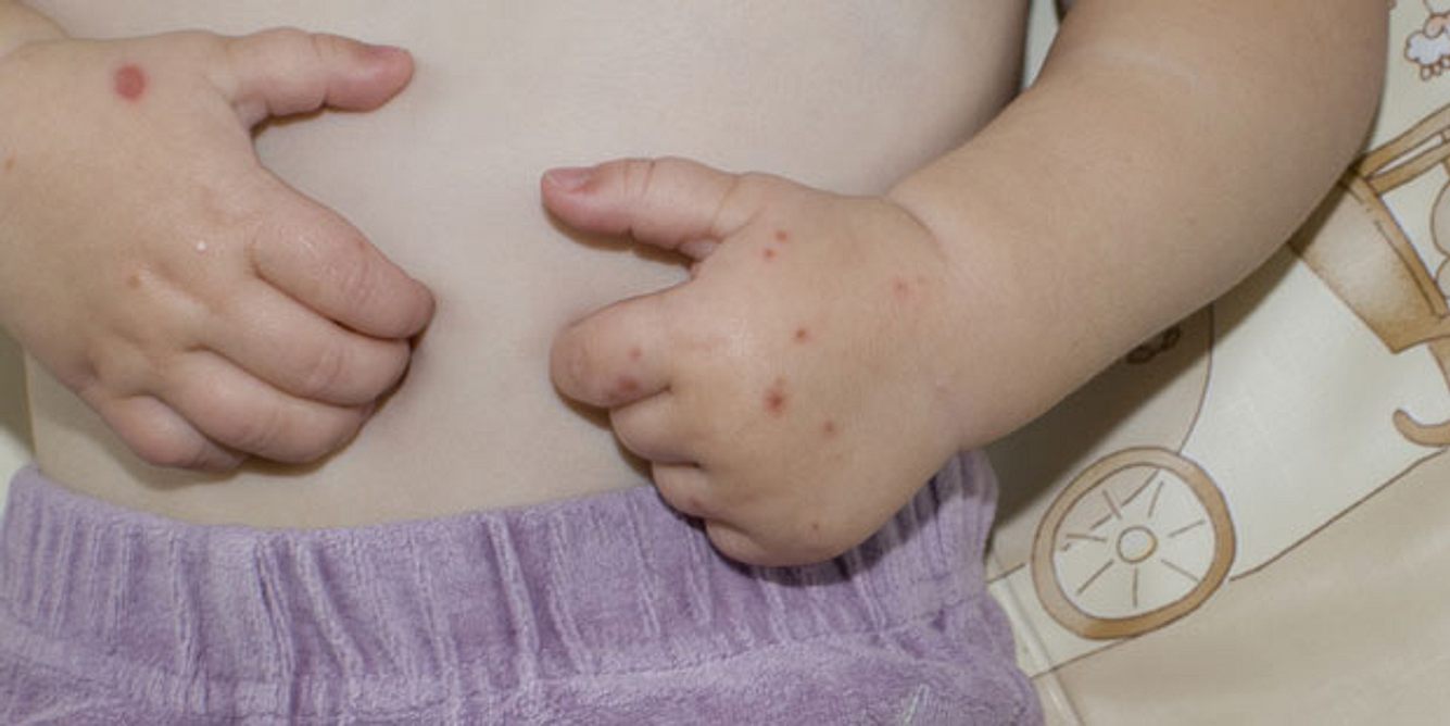 Kind mit Hautausschlag durch Hand-Fuß-Mund-Krankheit