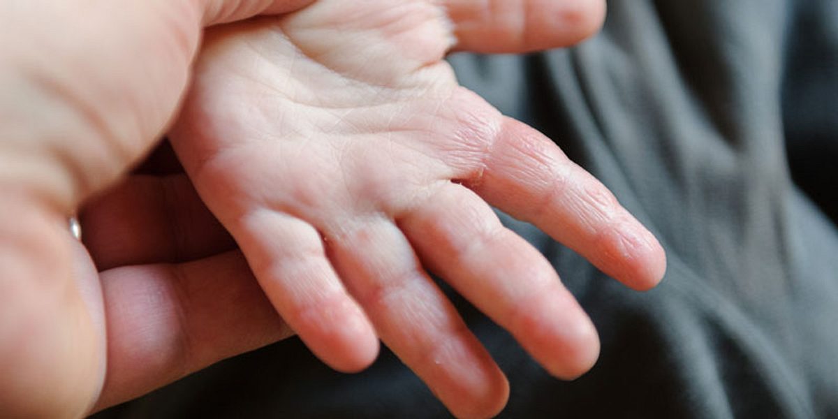 Hand-Fuß-Mund-Krankheit Symptom Ausschlag an den Händen